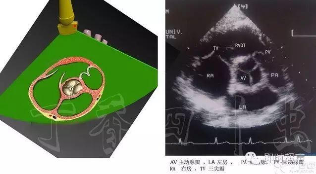 左室短轴切面_3d图解心脏解剖与心脏超声切面