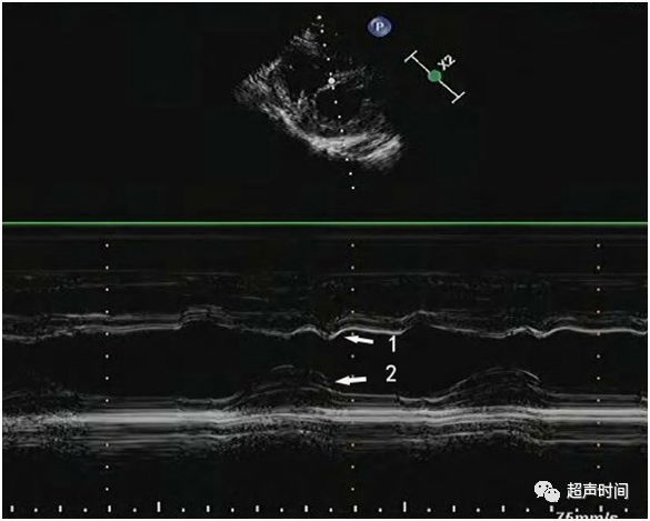 心包轻微舒张鸿蒙,超声新手福利:缩窄性心包炎