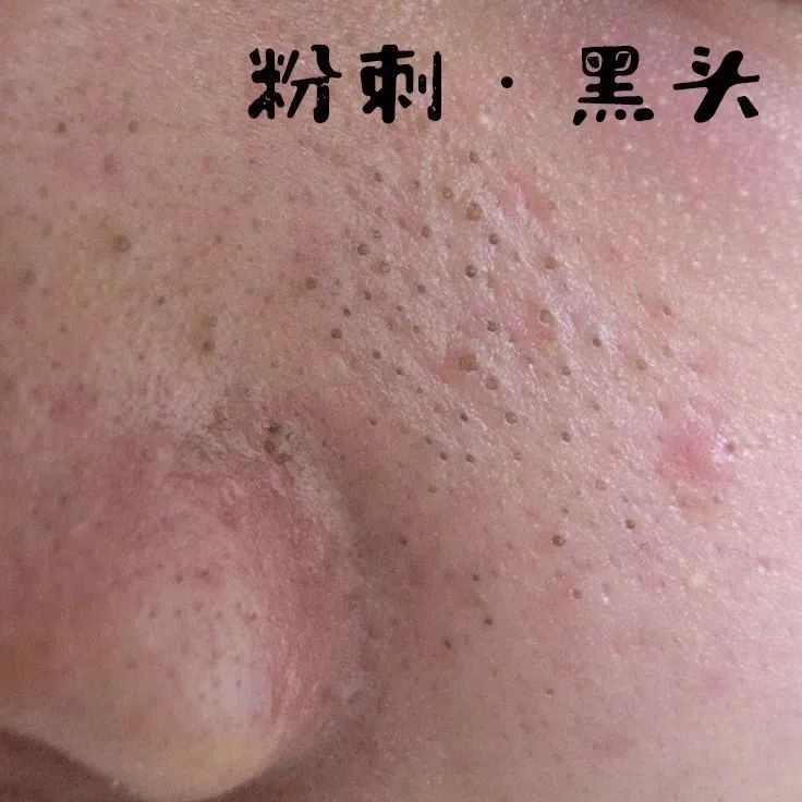 也就是说,毛孔堵塞不是因你肌肤表面脏或者空气脏,而是你新陈代谢减弱