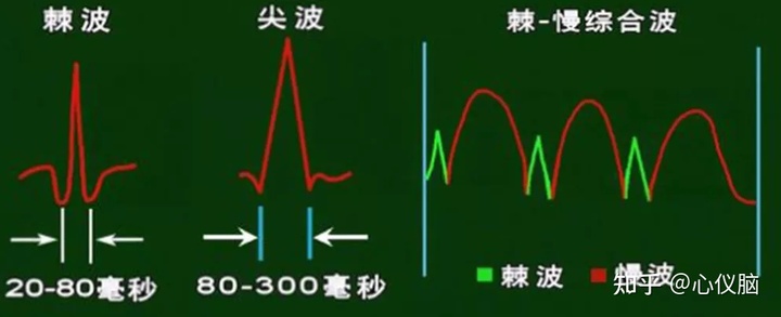 脑电图显示正常 Csdn