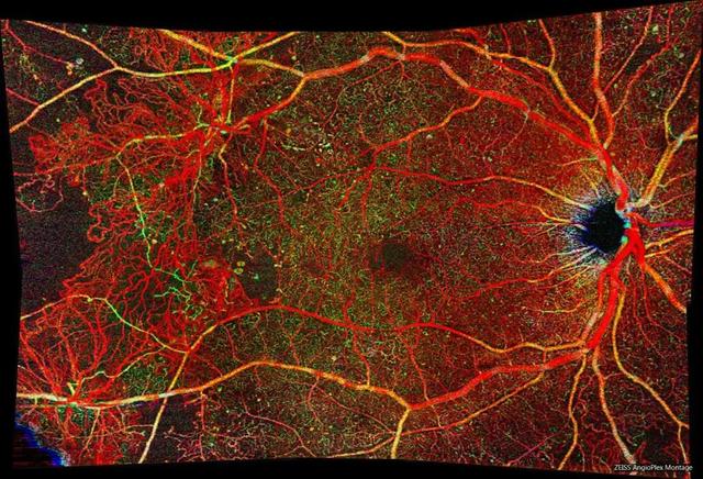 视网膜正常oct图咸阳市首台血流oct落户咸阳市第一人民医院