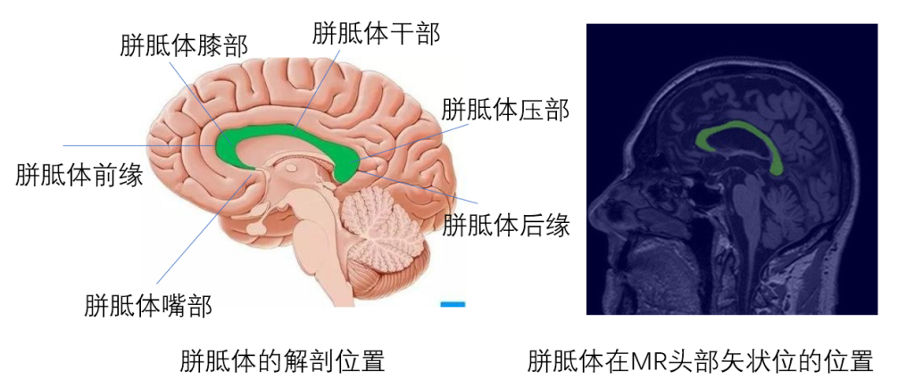 胼胝体在脑部的位置图图片