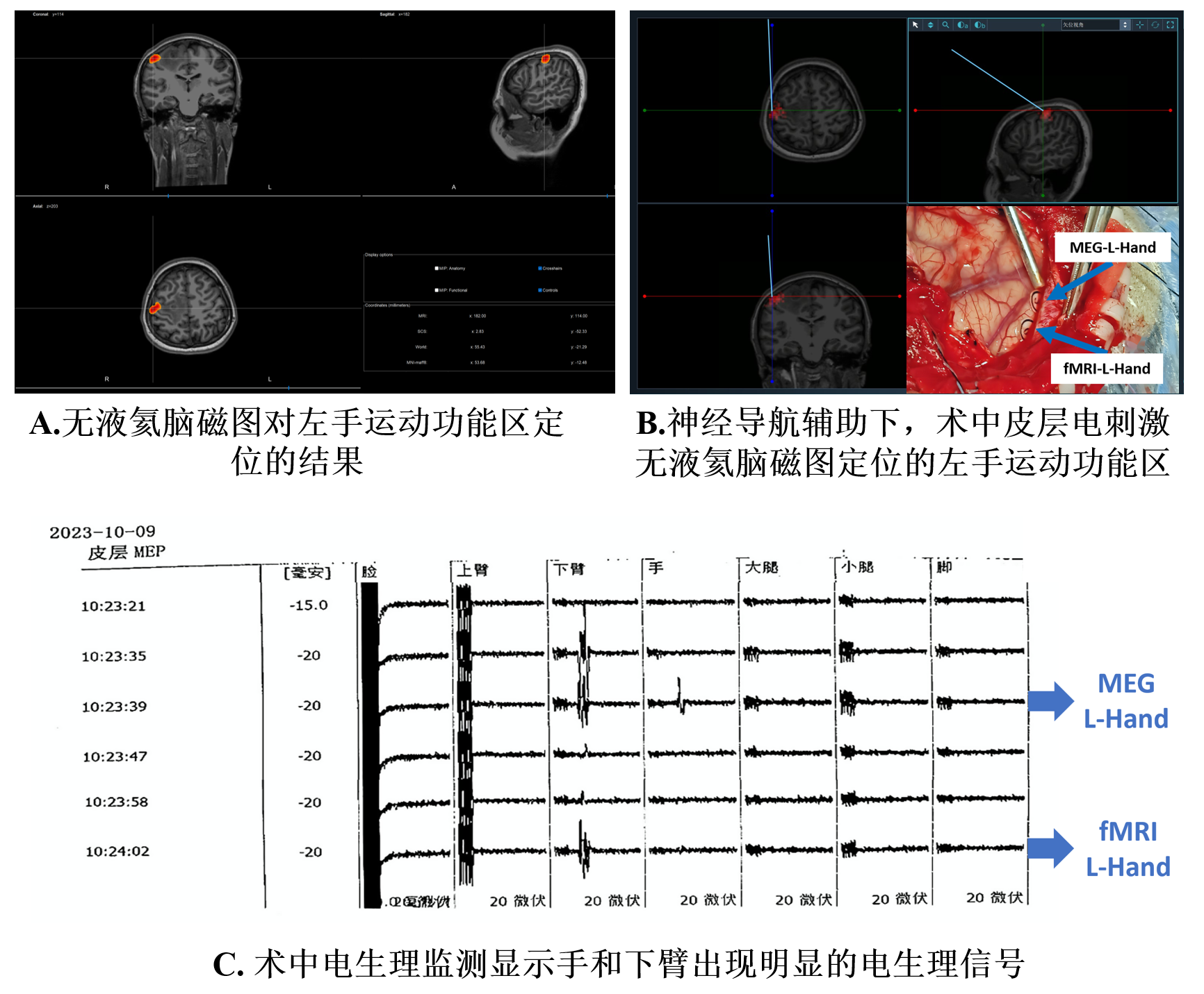 全球首例无液氦脑磁图辅助下的胶质瘤切除手术顺利完成