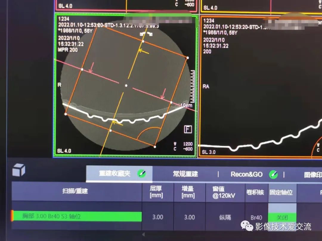 西门子CT重建算法