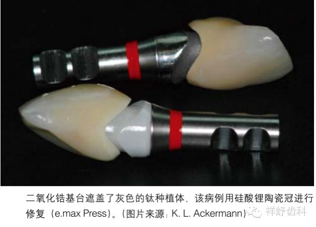 基台和种植体如何连接_CAD/CAM个性化基台功能及优势-CSDN博客