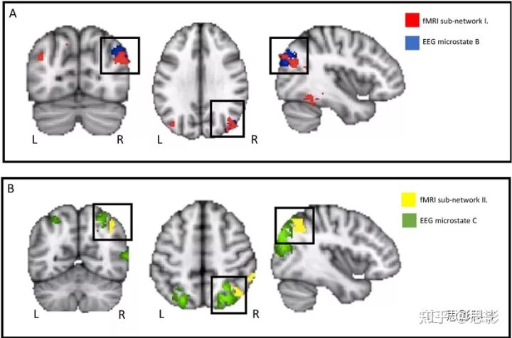 利用脑电和功能磁共振成像(fMRI)捕捉自我生成、任务启动的思维的时空动态_双侧颞下回区域-CSDN博客