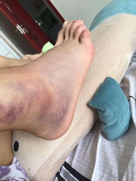 痛感不算严重的话,则大多是软组织损伤,这个可以不需要去医院就医