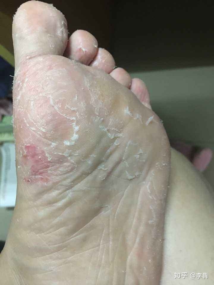 引发类型为systemwebhttpunhandledexception脚气的4种类型和10种级别