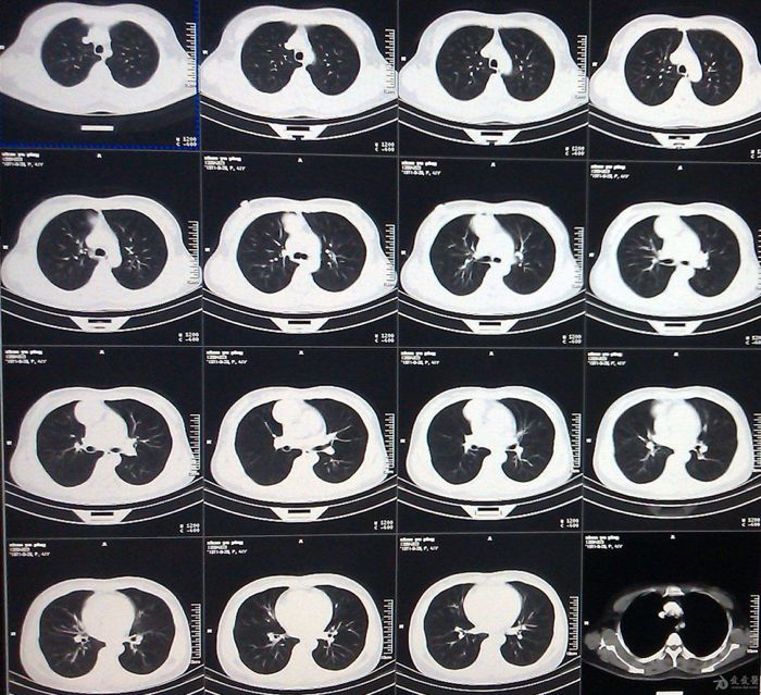 肺结节目标检测一根烟上热搜先让ai看看你的肺