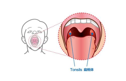 小孩扁桃体肿大3度能自愈吗?6岁小孩扁桃体肥大怎么治效果好?