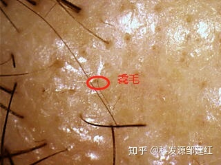 图片上标注的毳毛,是雄脱秃发部位的萎缩毛囊长出的像汗毛一样的毛发