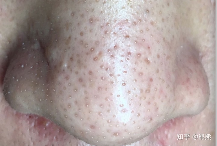 input checkbox 背景色去不掉_黑头去不掉,那是因为你遇上了假黑头!