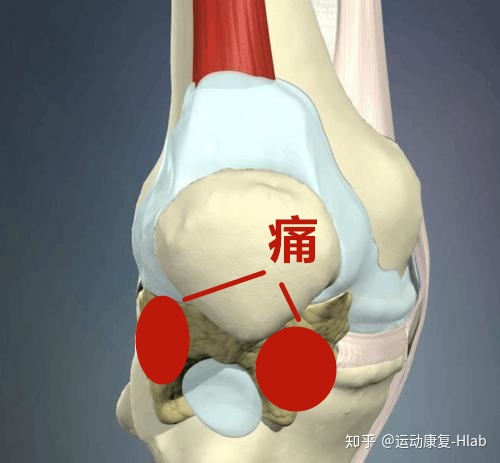 怎么判断膝关节错位超全膝关节疼痛地图