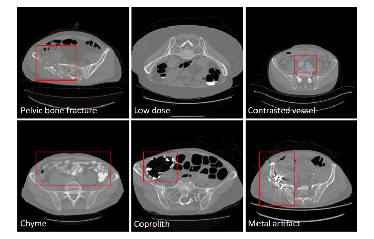 文献速递：人工智能<span style='color:red;'>医学</span><span style='color:red;'>影像</span><span style='color:red;'>分割</span>--- <span style='color:red;'>深度</span><span style='color:red;'>学习</span><span style='color:red;'>分割</span>骨盆骨骼：大规模CT数据集和<span style='color:red;'>基线</span>模型