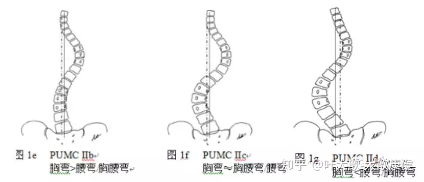顶椎上在t3,t4,下在t11,t12;体征会有明显的高低肩,高低背,肩胛骨高低