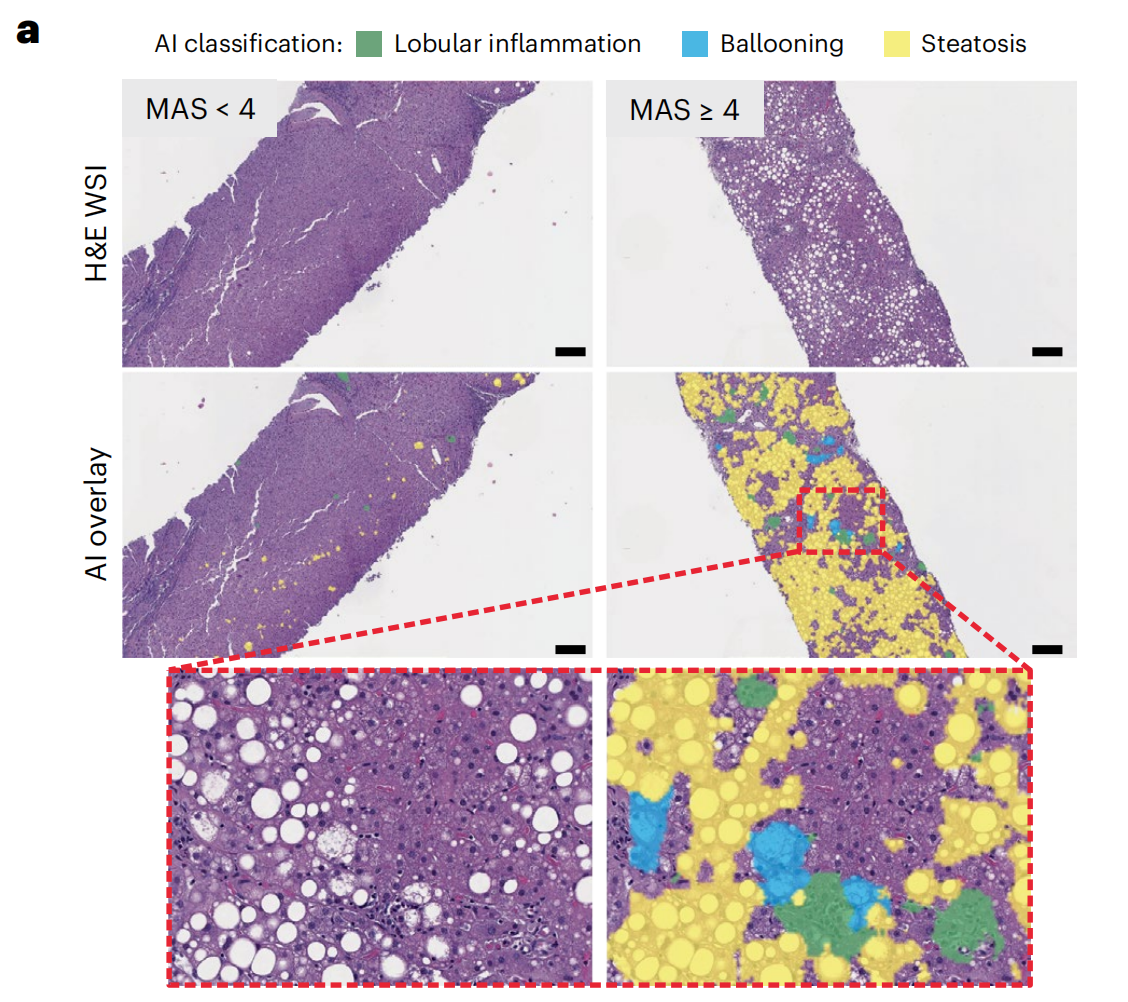 代表性的H&E染色切片显示AI叠加层突出显示了脂肪变性、小叶炎症和气球样变的区域