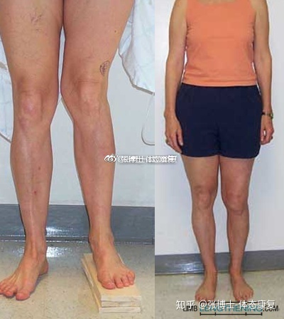 怎么调整字段长短体态矫正关于长短腿的类型检测方法与矫正训练