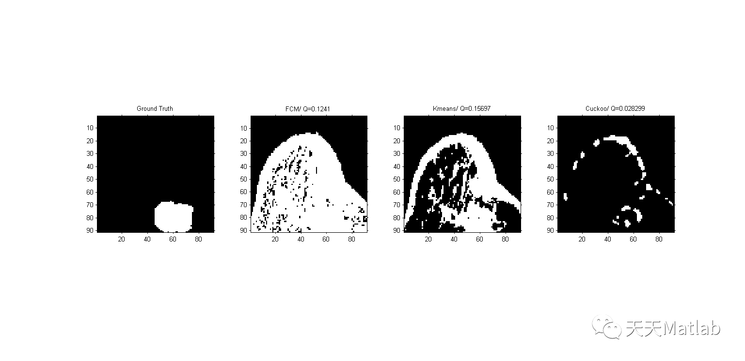 【图像分割】基于Kmean聚类实现乳腺肿瘤分割附matlab代码