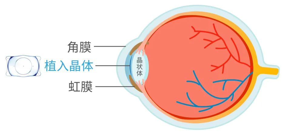 近视手术能不能做 怎么做 丁香医生告诉你 Hello World Csdn博客