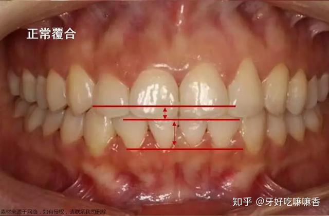 前牙正常覆盖是多少如何区分深覆盖和深覆颌它们有什么不良影响