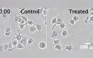 显微镜下的胰腺癌细胞 悠哉生长和被灭现场