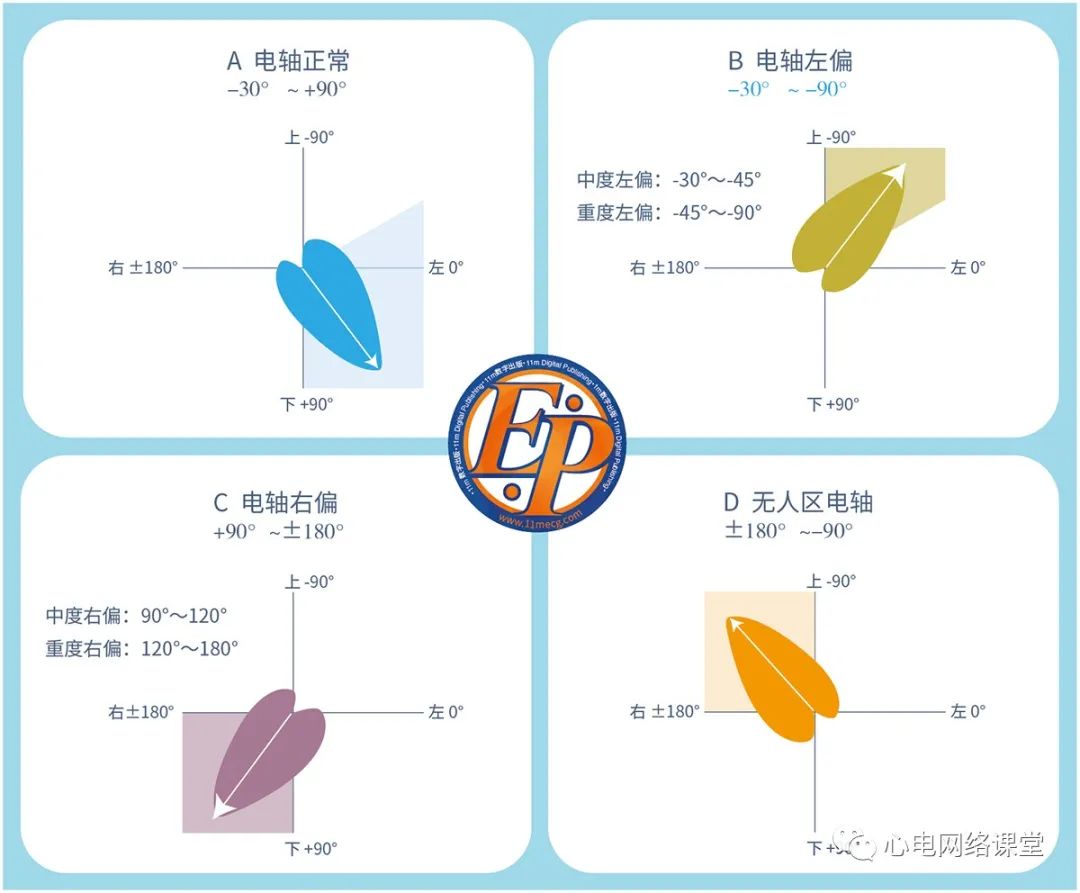 无人区电轴心电图识别图片