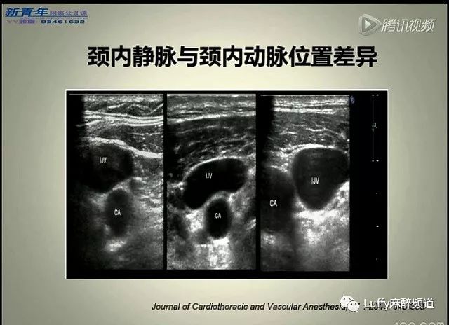 颈内静脉瓣膜的问题锁骨上超声引导下锁骨下静脉置管在儿科和新生儿