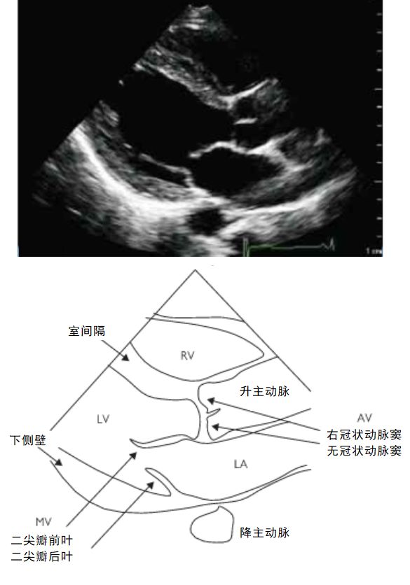 左室流出道切面图片