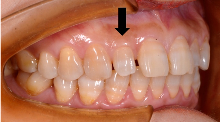 2,牙齿大小形态异常上中切牙间存在两颗多生牙,拔除后将形成巨大的
