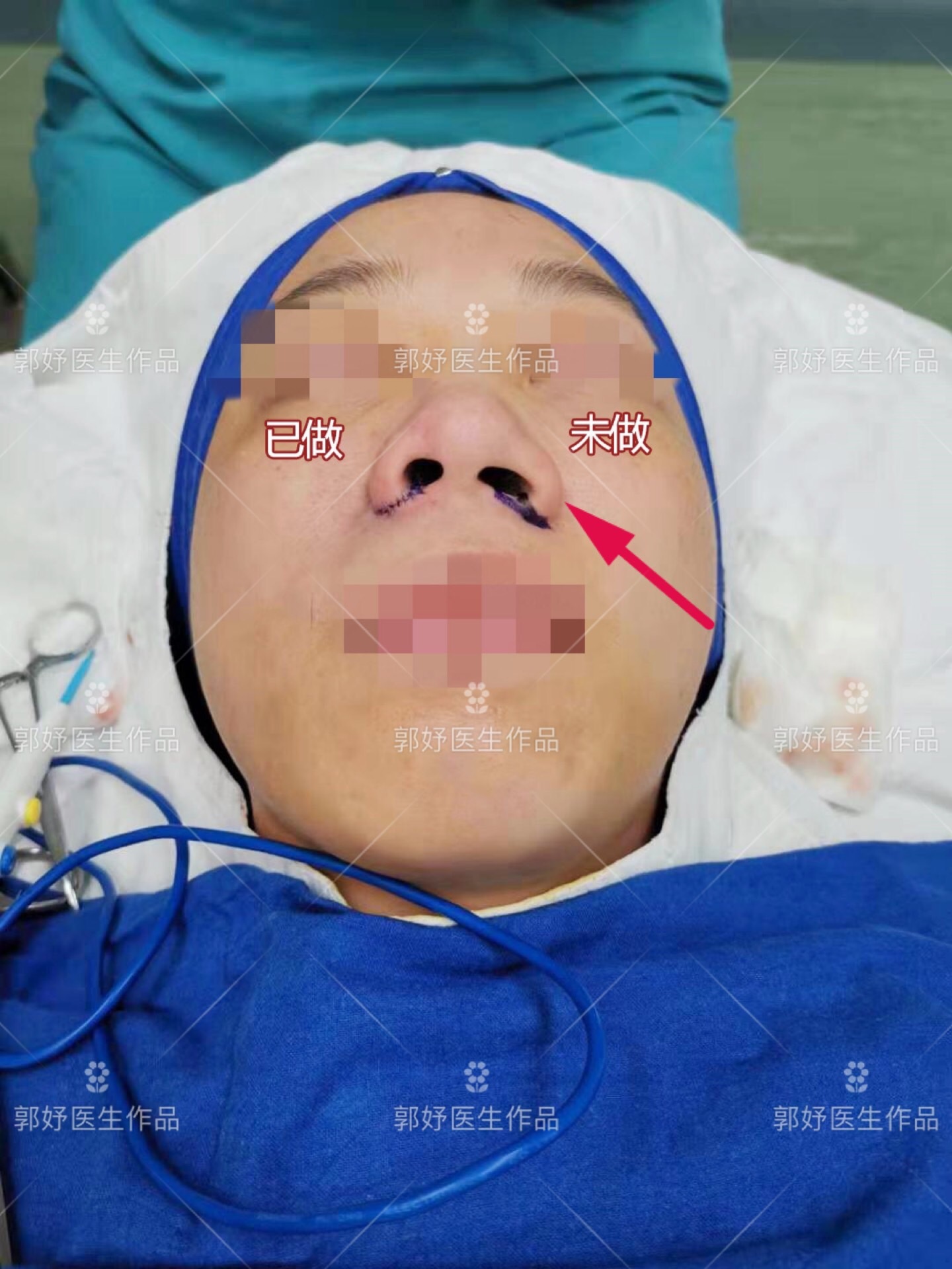 双线性内插怎么缩小_鼻翼缩小该做内切还是外切?会留疤吗?