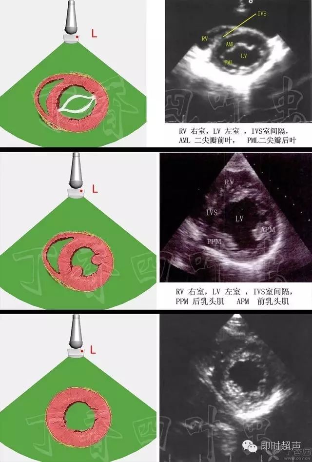 左室短轴切面_3d图解心脏解剖与心脏超声切面