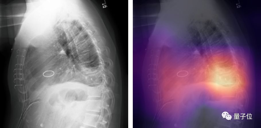 x光肺部分割数据集_吴恩达发布了大型X光数据集，斯坦福AI诊断部分超越人类 | AAAI 2019...