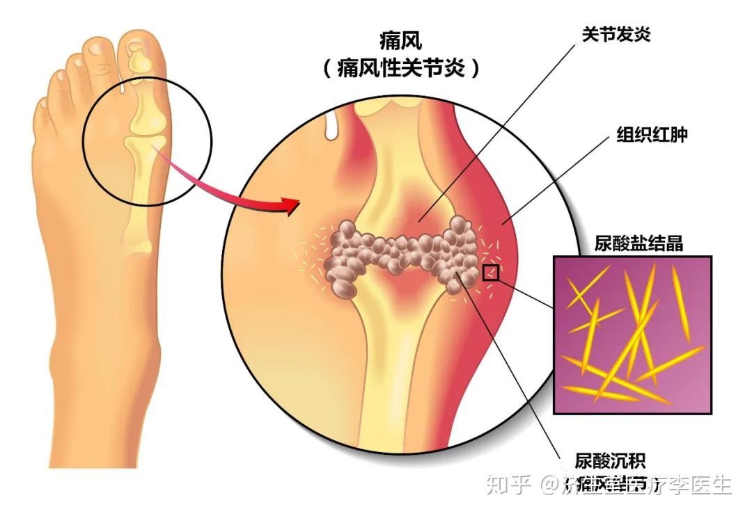 痛风的预防与治疗