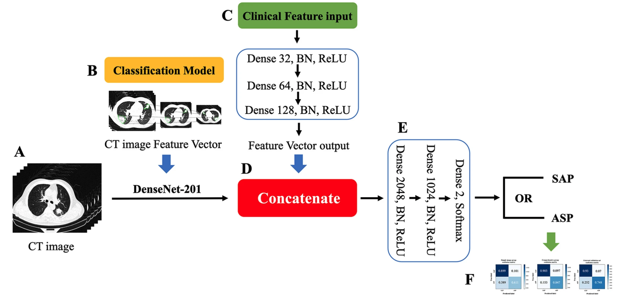 ( A )预处理的CT图像集 ( B ) 用于从 CT 图像集中提取特征向量的骨架网络 DenseNet-201 （C）临床信息（临床症状、实验室结果、影像特征）的输入被输入到三层深度神经网络（DNN）中，用于训练和提取临床特征向量 ( D )临床和图像特征向量的收敛和连接 ( E )融合临床和图像特征向量信息后，输入两层DNN进行训练，最后由两个神经元的DNN输出分类和诊断结果 ( F )混淆矩阵可视化分类诊断结果