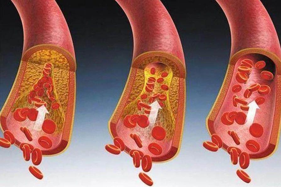 血脂高的全身表现，这几种吃法改善