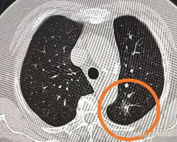 改變bantchsize發現loss增大肺內發現磨玻璃結節一定就是早期肺癌嗎