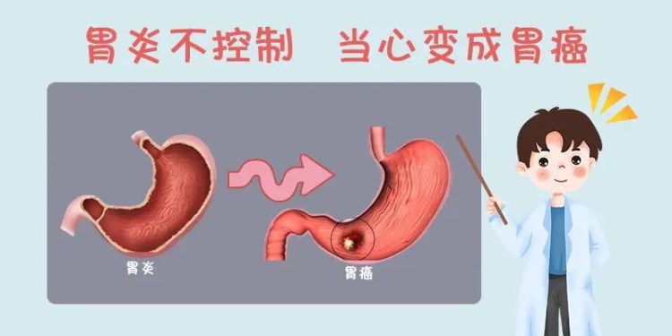 胃炎的正确疗法