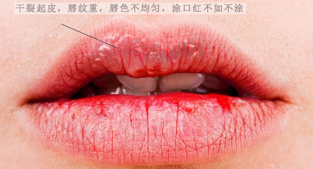 瞬间显老10岁一嘴的干裂,死皮,唇纹除了难受吃饭,喝水都费劲,哪里还会