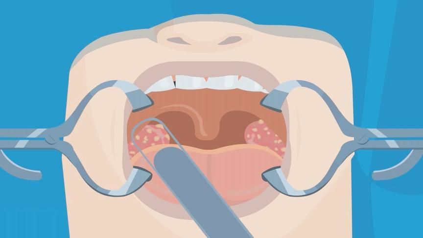扁桃体肥大对儿童有什么影响？怎么办及怎样才能消下去？