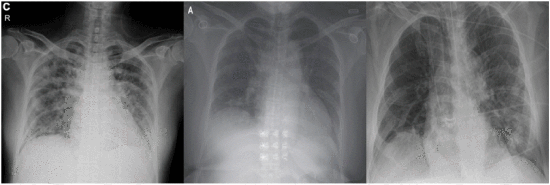 COVID-19患者的胸部X光图像样本