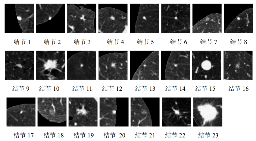 肺结节检测项目 | 基于CNN+LSTM实现的肺结节CT图检测算法