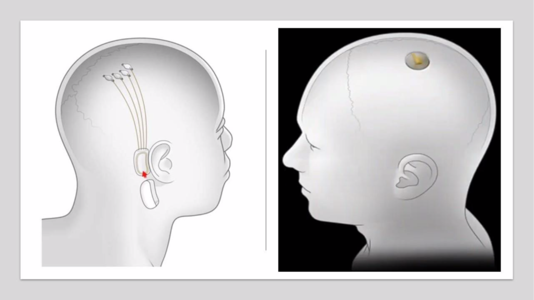 哈佛专家披露：马斯克侵入式脑机接口技术的三个进展与三大局限