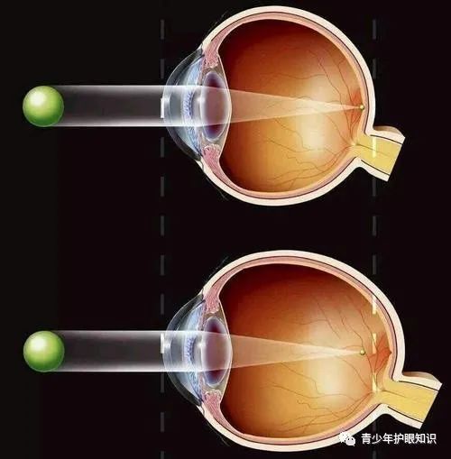 16岁眼睛近视500度图片