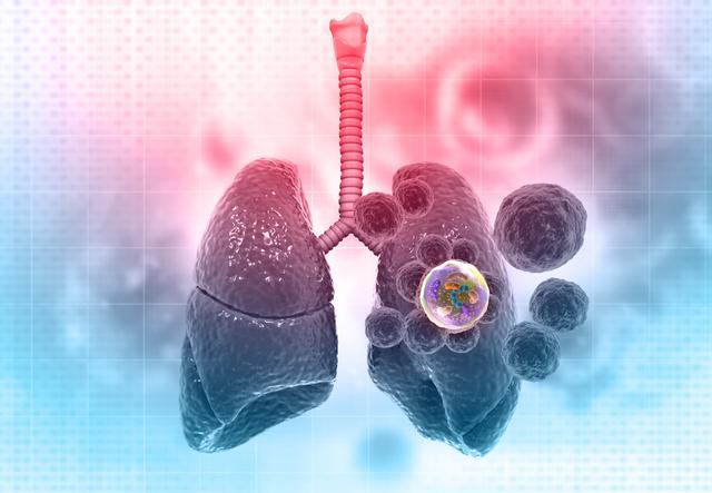 肺癌二期治疗效果与方案