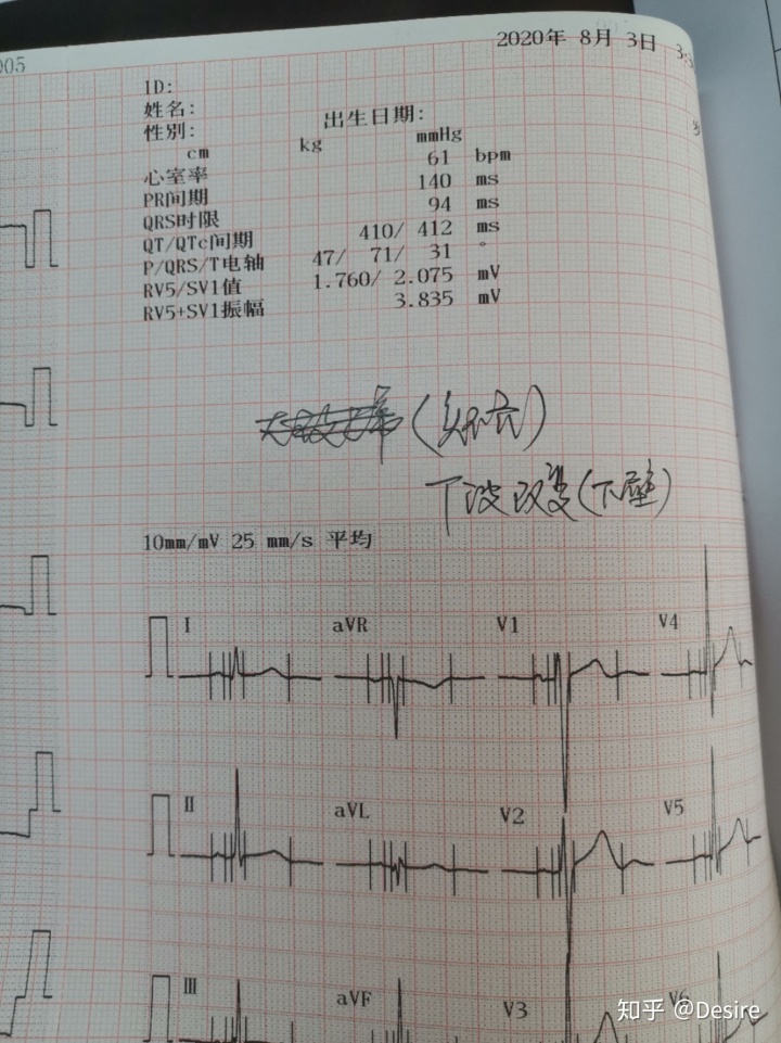 心电图前波过多_今年征兵初检不正常心电图,我该如何面对复检