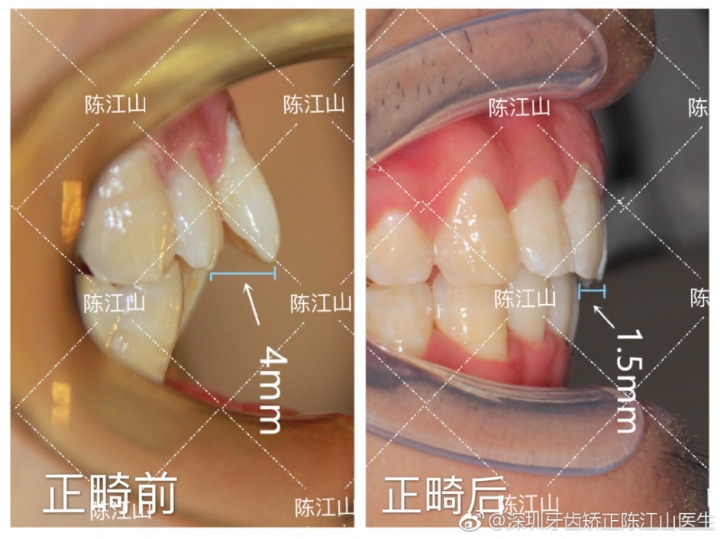 前牙正常覆盖是多少牙齿矫正科普深覆合和深覆盖有什么不同该如何矫正