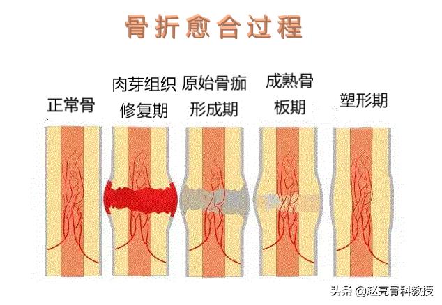 张先生是什么意思骨科医生告诉你骨折后吃什么有助康复愈合