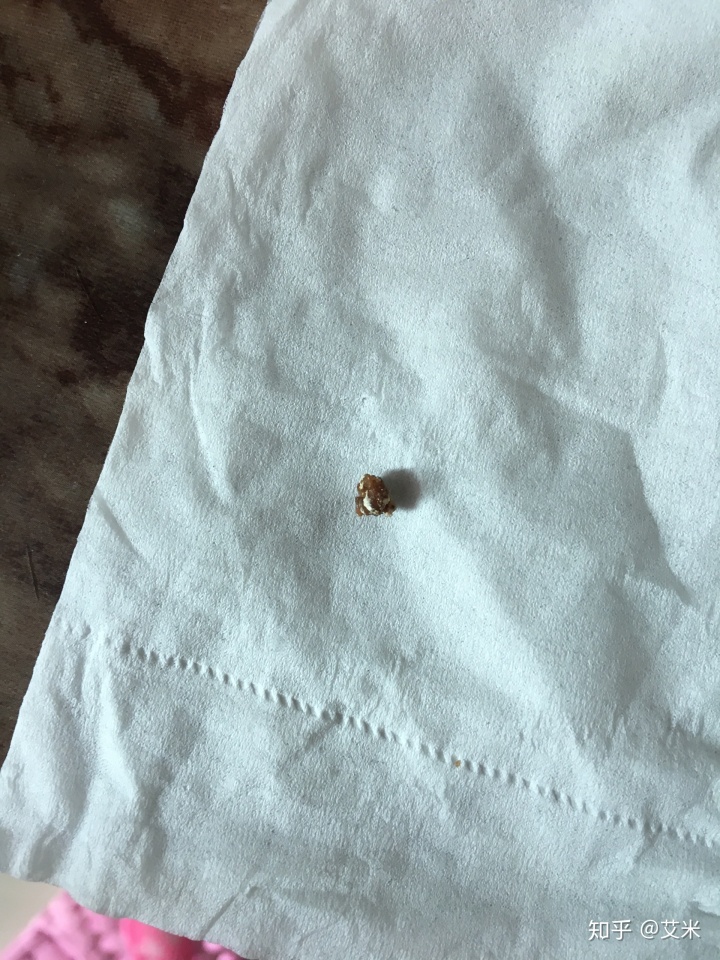 一直跳出来visual六天时间排出来肾结石这种经历再也不要了