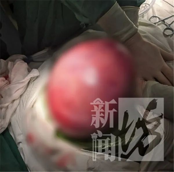 小腹右侧突然疼了一下老来得子52岁大妈突然小腹隆起