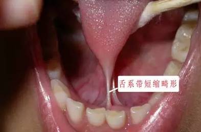 下排牙齿中间高两边低牙齿整形这20种牙颌畸形问题需要在12岁前解决